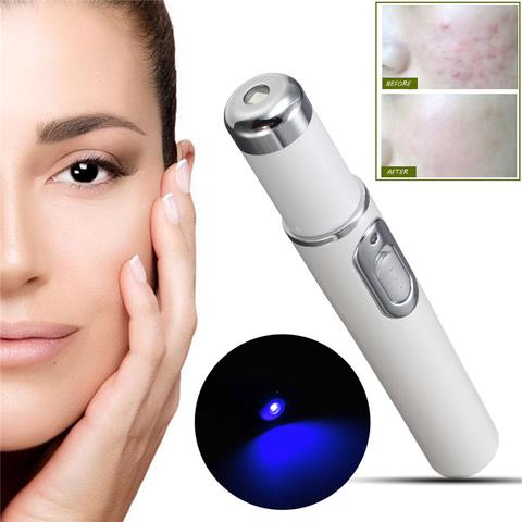 Harnessing the Power of Blue: Blue Light Therapy Acne Laser Pen for Skin Enhancement - Little Commodities